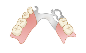 部分入れ歯